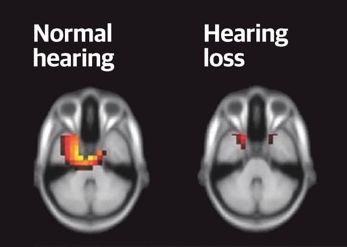 Hearing loss and Dementia — the verdict is in post image